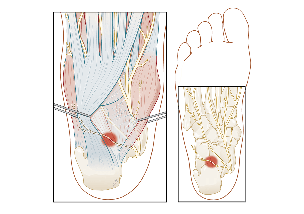 Een operatie bij zenuwbeknelling in de hiel wordt pas overwogen bij aanhoudende hielpijn en onvoldoende effect van andere behandelingen.